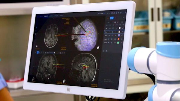 中国自研无线皮层脑机接口植入人脑通道数破世界纪录：已完成第三例