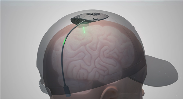 用意念玩游戏！我国开展首例侵入式脑机接口临床试验