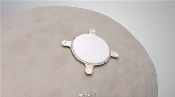 用意念玩游戏！我国开展首例侵入式脑机接口临床试验