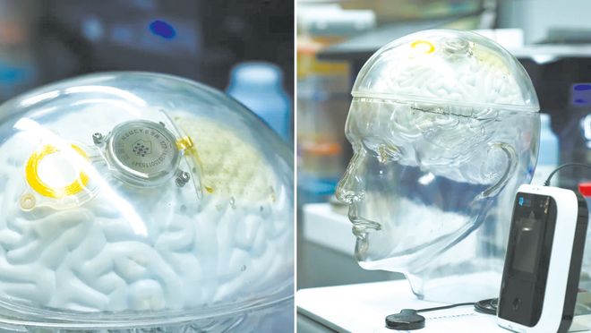 北京脑科学与类脑研究所研制的“北脑一号”脑机接口芯片(左)与植入后的效果示意模型(右)。(图源:CNN)