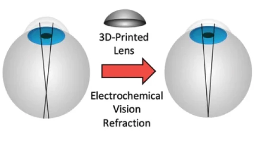 科学家开发出无需进行LASIK等手术即可矫正视力的方法