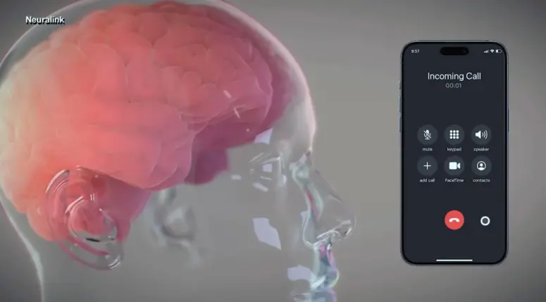 Neuralink芯片入脑让瘫痪男子重新开口