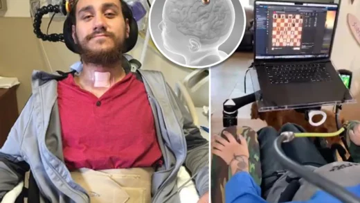 脑机接口首位植入者讲述与大脑芯片共存：难熬但重新振作