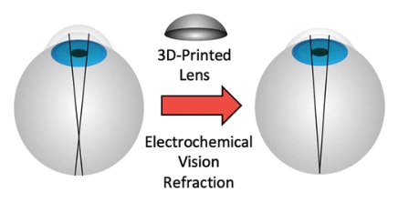 科学家开发出无需进行LASIK等手术即可矫正视力的方法