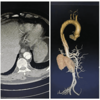 全球首款！浙大一院、阿里发布主动脉急诊AI模型：准确率高达99.4％