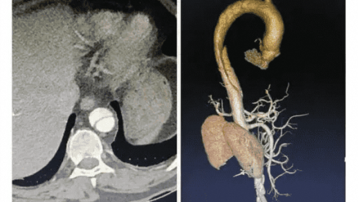 全球首款！浙大一院、阿里发布主动脉急诊AI模型：准确率高达99.4％